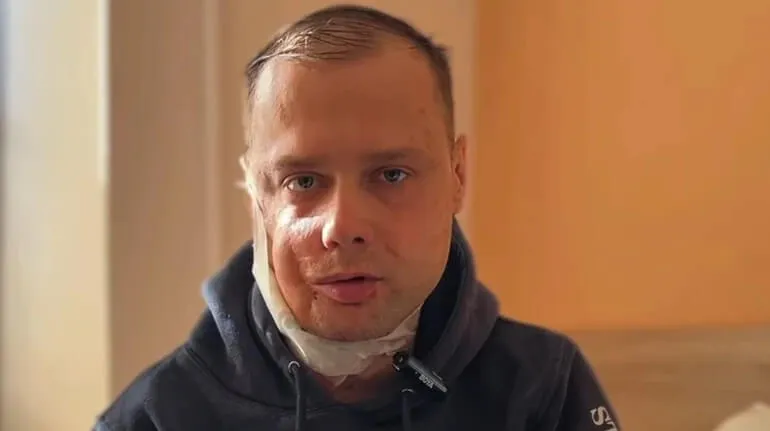 Львівські хірурги реконструювали обличчя ветерану після 18 операцій