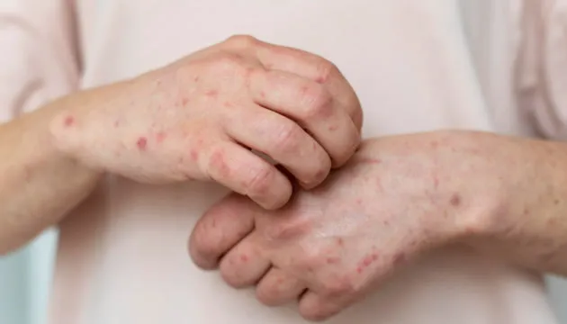 На Прикарпатті ліквідували п’ять спалахів кору