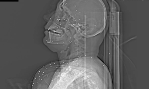 Пошкоджені очі, груди та геніталії, рентген розкриває наслідки обстрілів в Ірані