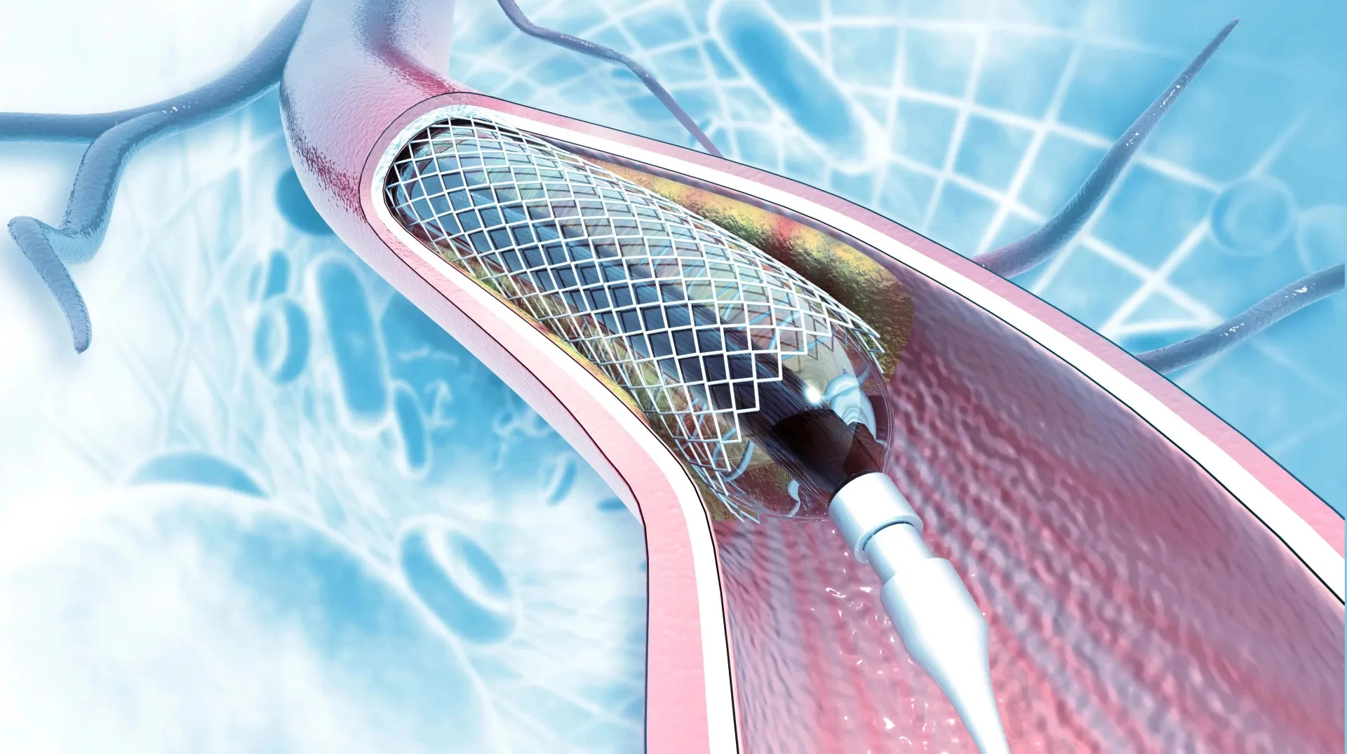 Українцям із серцевими хворобами буде доступне безоплатне стентування — МОЗ