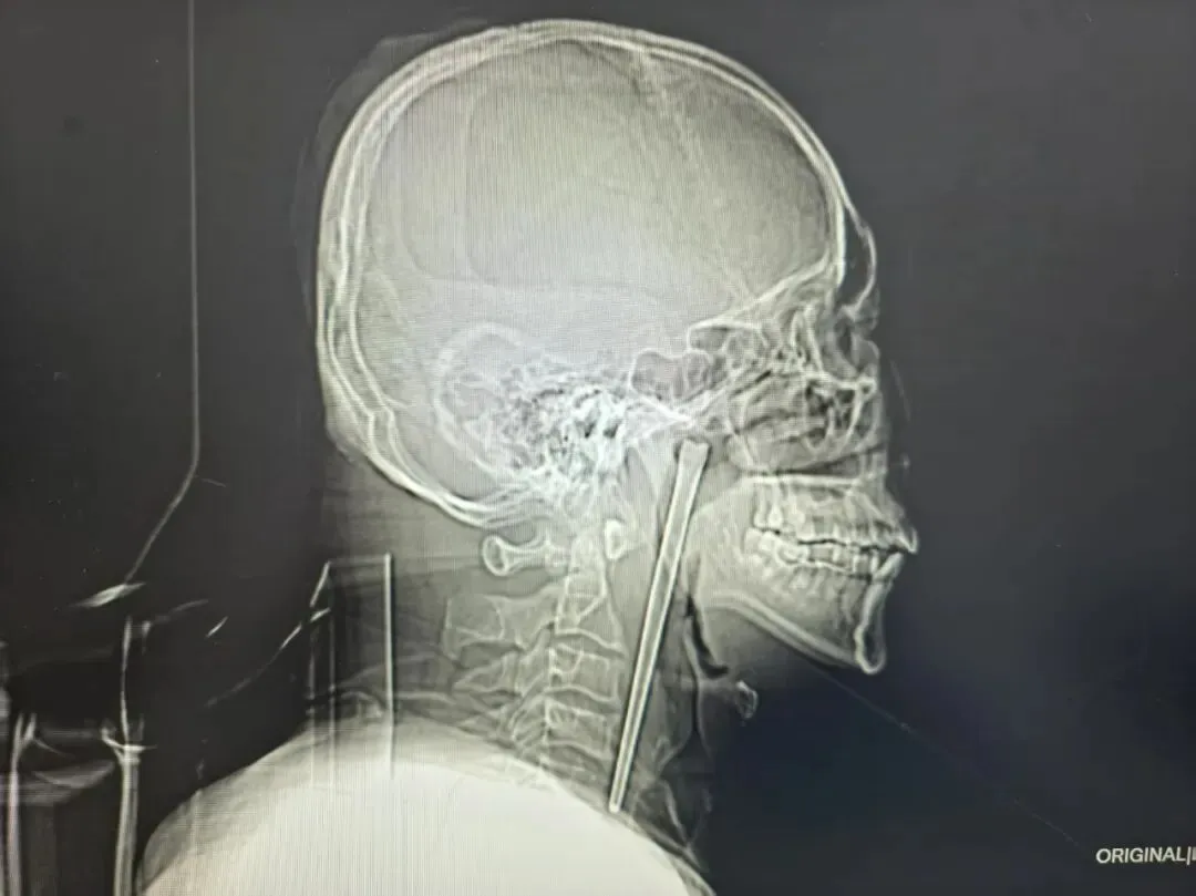 Китаєць жив вісім років із паличкою в горлі