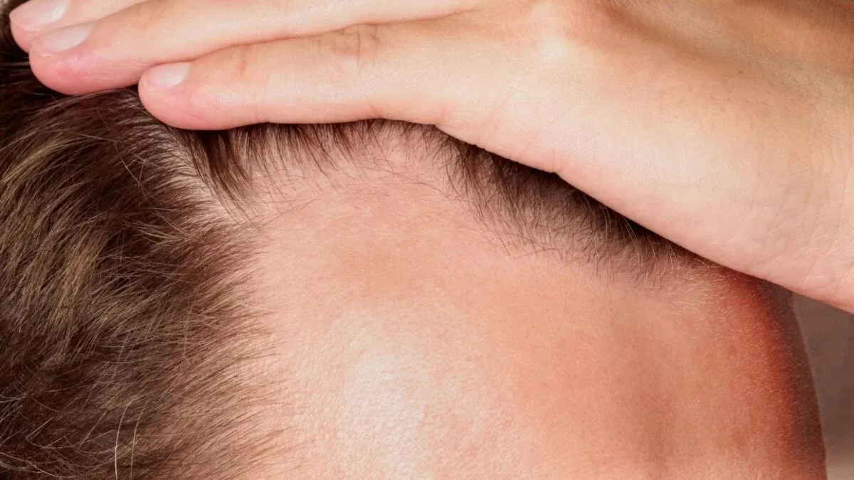 New Baldness Drug Increased Hair Growth by 539% in Trials