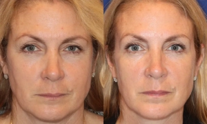 В Україні зафіксували два випадки кору