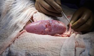 Фото: хирурги впервые успешно пересадили почку, выращенную в теле свиньи