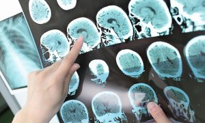 После 20 лет исследований. В США начинаются испытания вакцины от болезни Альцгеймера