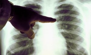 Нестандартные решения. Крошечные роботы победили смертельную пневмонию