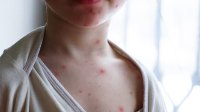 ВООЗ схвалила перший тест на мавпячу віспу для екстреного використання